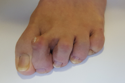 Person with hammertoes condition